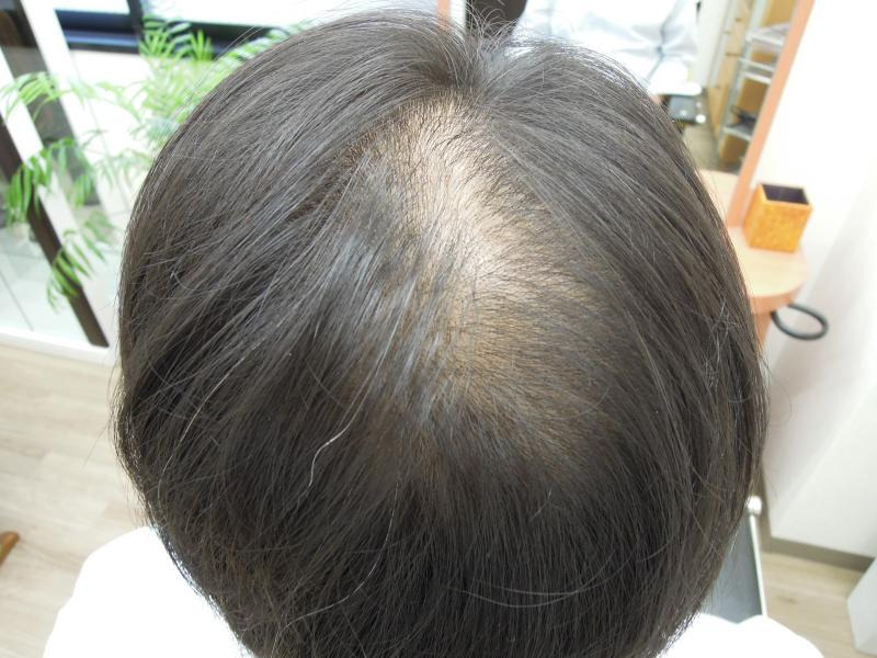 後頭部の増毛