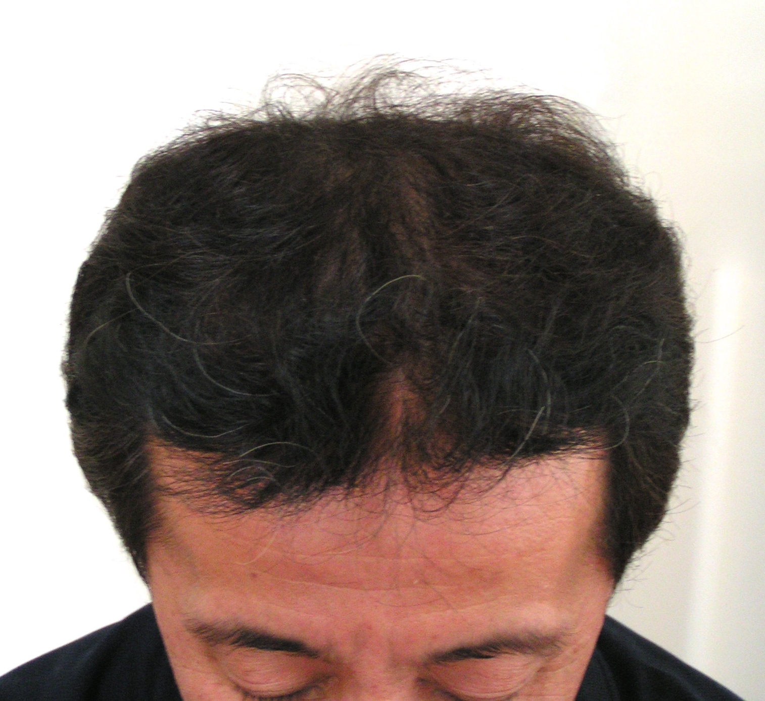 前髪の増毛は少しづつ増やす。