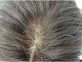 動画　育毛の個人的見解です。ご参考になれば幸いです。