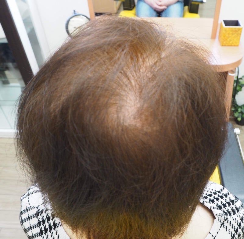 増毛の費用について。