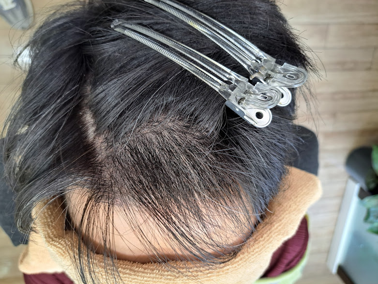 増毛こんな時に便利です。（画像あり）