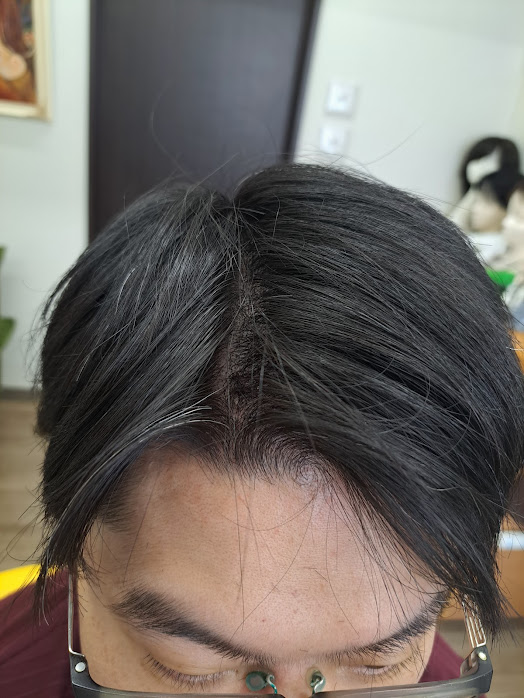 大人気です。エアスキン増毛。