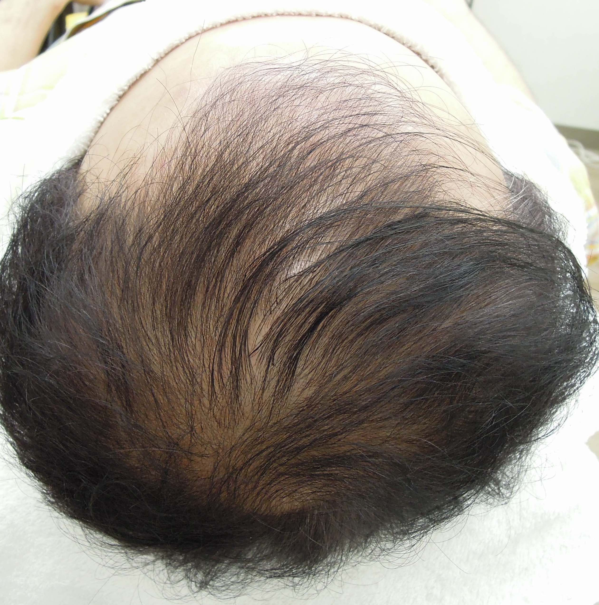 AGA治療の考えをお話ししました。（動画）