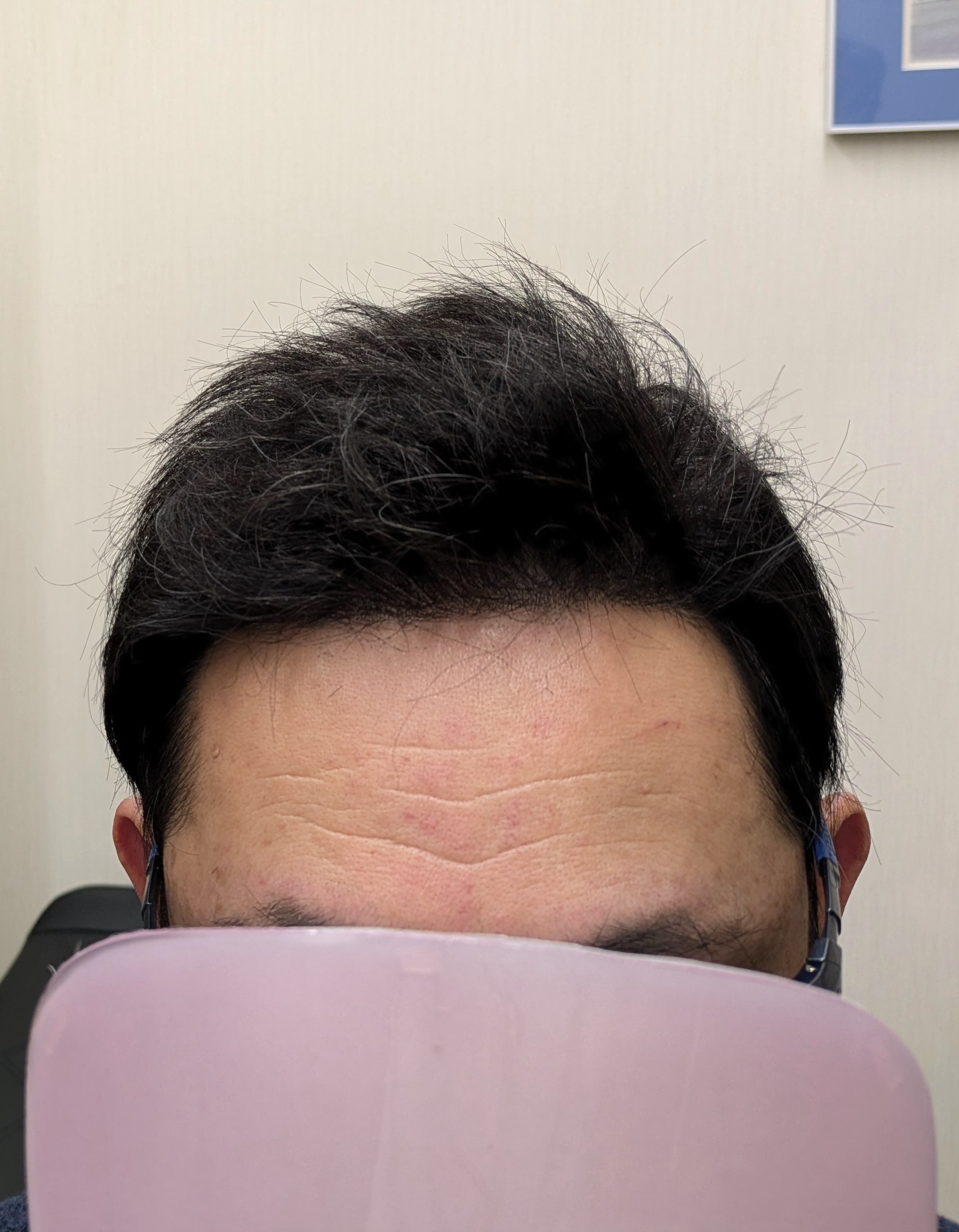 スキンベースを痛ませないテープの貼り方。（動）